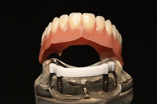 Implantatversorgung aller Ar